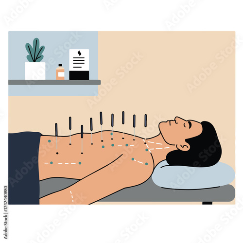 A person lying down with acupuncture needles inserted into their back and neck