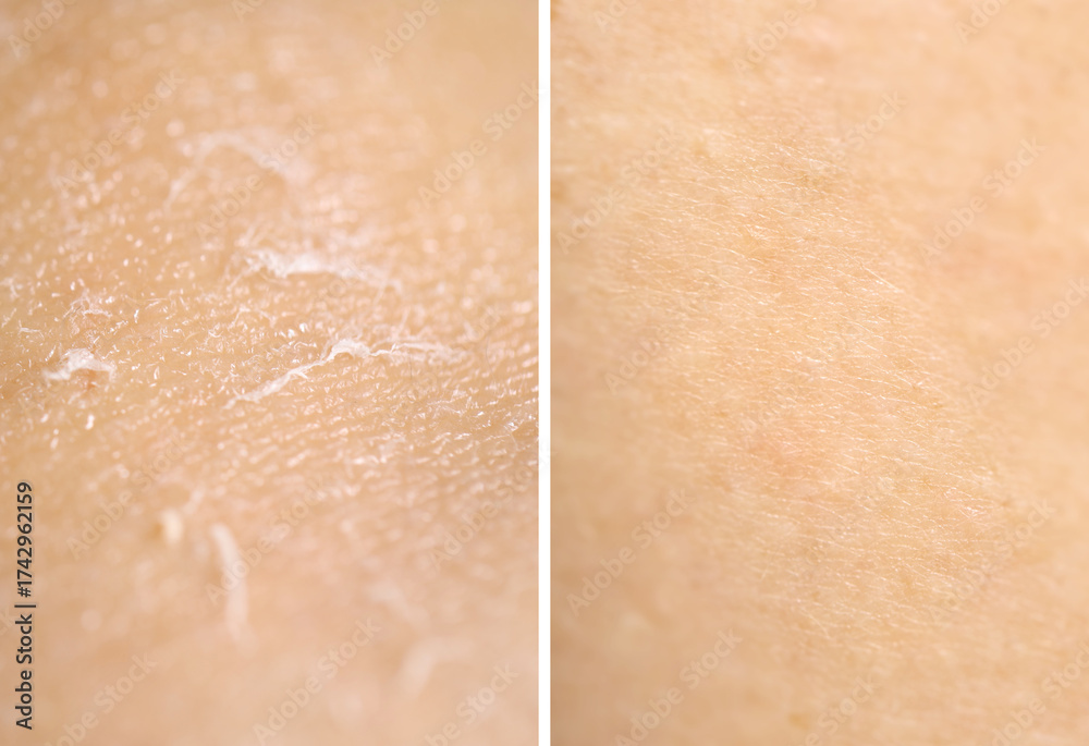 Fototapeta premium Dry skin on one side and moisturized on another, collage before and after