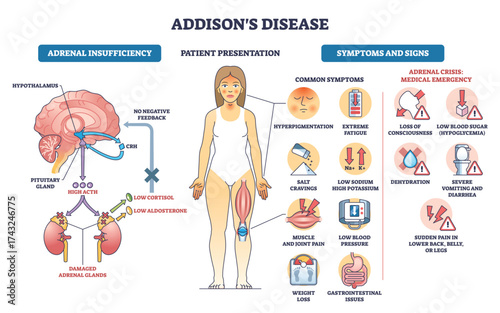 Addisons disease outline illustrates adrenal insufficiency, HPA axis, symptoms, and crisis alerts, key objects, adrenal glands, pituitary-brain, patient figure. Outline diagram