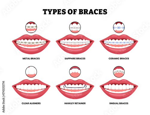 Different types of braces types set collection. Dental bracket teeth retainer. Labeled metal, sapphire, ceramic, lingual, hawley retainer and clear aligners. Tooth mouth, orthodontic aligner swanky.