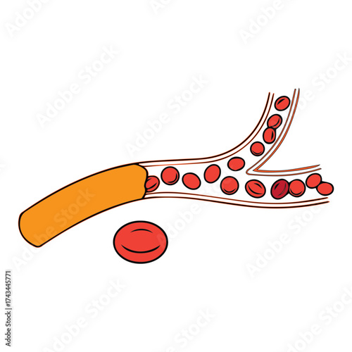 Blood Vessel Obstruction