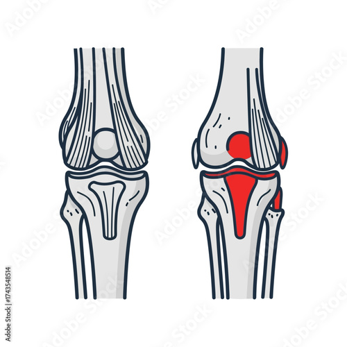 Medical illustration comparing a healthy human knee joint with one showing signs of inflammation or arthritis.