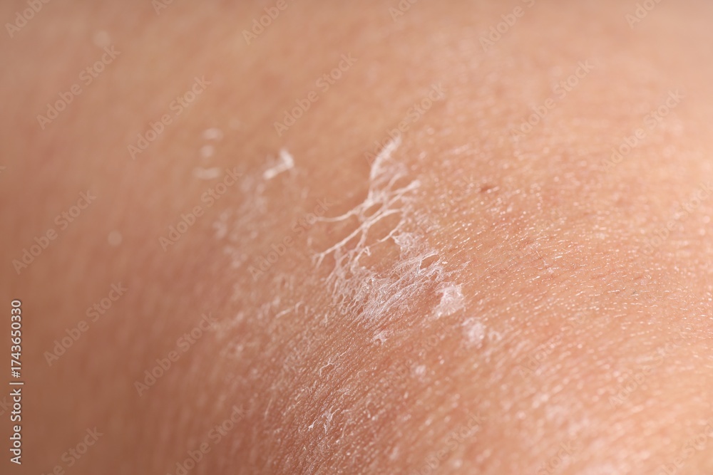 Fototapeta premium Closeup view of woman with dry skin