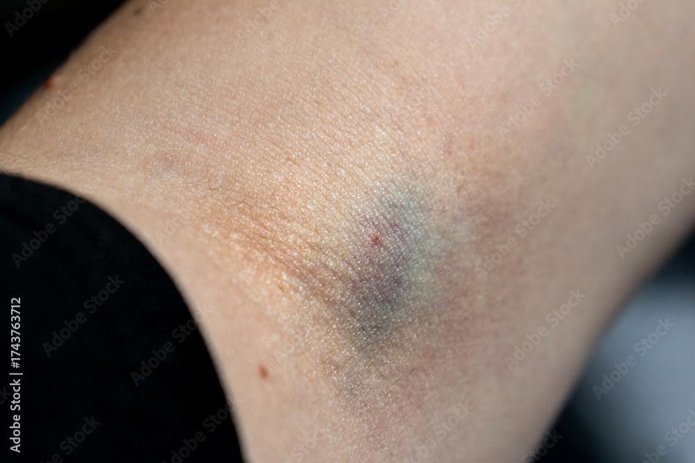 Fototapeta premium Bruise on arm after blood test, hematoma