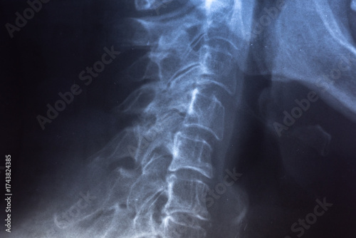 Side X-ray scan with displacement of intervertebral discs and herniation in the cervical spine.