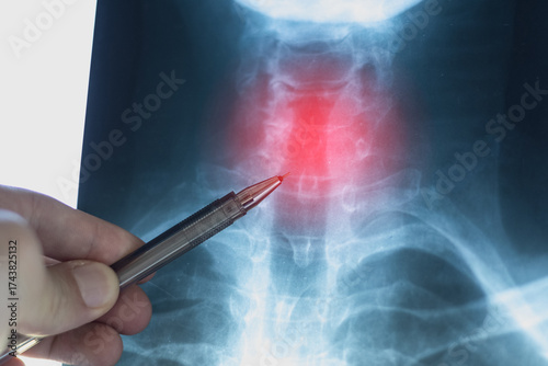Doctor learning X-ray scan with displacement of intervertebral discs and herniation in the cervical spine.
