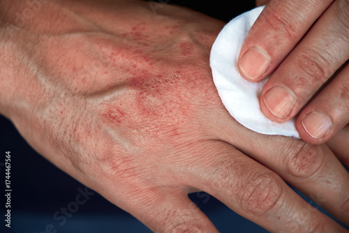 Close-up of hands with dry, irritated skin showing symptoms of eczema or dermatitis. Skin care or medical condition concept isolated on a white background.