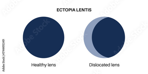 Ectopia lentis disease