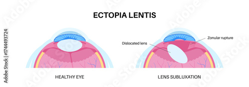 Ectopia lentis disease