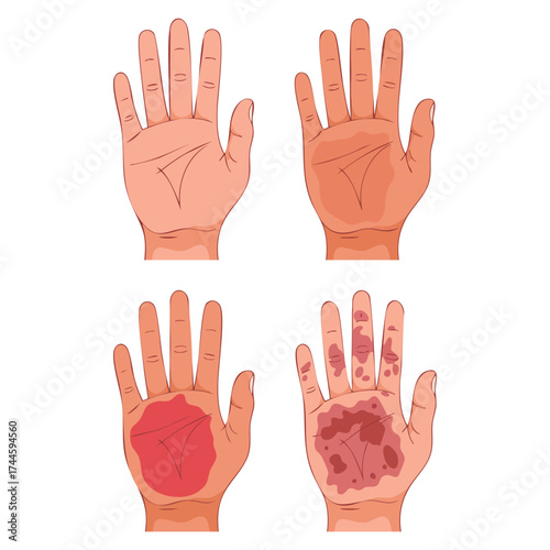 Burn of human hand skin different degree vector illustration showing first aid for fire chemical injury visual symptoms perfect for medical emergency educational materials