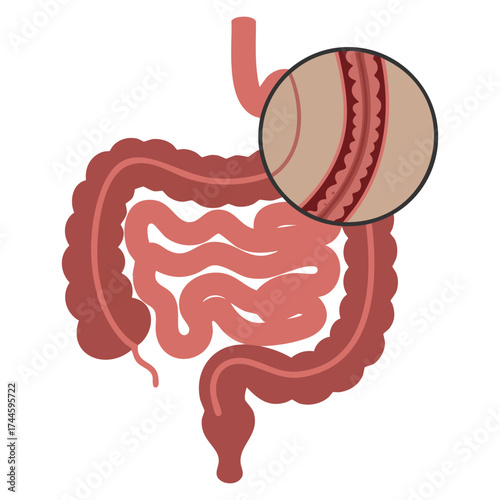 Intestine colonoscopy polypectomy and removal of polyp vector illustration ideal for surgery operation checkup and educational medical visuals