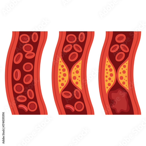 Normal and cholesterol blocked artery vector illustration showing blood clot thrombus atherosclerotic plaque deep vein thrombosis DVT and blocked circulation