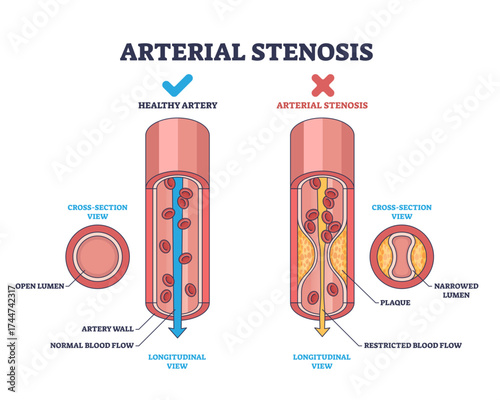 Arterial stenosis is shown by comparing a healthy artery and a narrowed artery with plaque, highlighting restricted blood flow, transparent background.