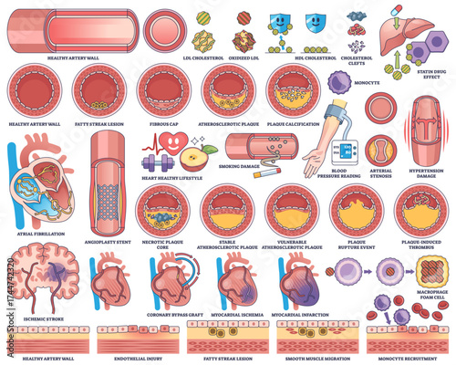 Atherosclerosis and cardiovascular disease are illustrated with artery cross-sections, heart diagrams, and plaque buildup, transparent background. Outline style worksheet collection