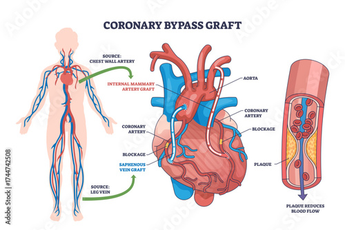 Coronary bypass graft surgery is shown with heart, blood vessels, and graft routes to bypass blocked arteries, transparent background.