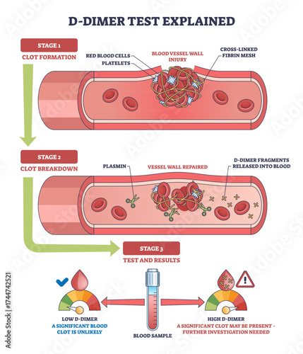 D-dimer test diagram shows blood vessel injury, clot formation, and breakdown with D-dimer fragments in blood, transparent background.