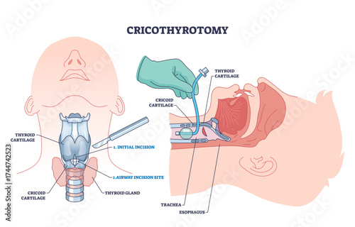Cricothyrotomy procedure diagram shows incision, airway, and anatomical landmarks for emergency airway access, transparent background.