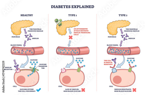 Diabetes types explained with an outline diagram showing pancreas, blood vessel, and cell to illustrate insulin function and glucose uptake, transparent background.