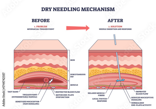 Dry needling mechanism shows needle insertion into muscle trigger point, illustrating blood flow and muscle response, transparent background.