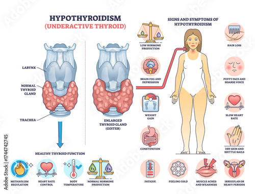 Hypothyroidism is shown with a thyroid gland diagram, symptoms, and hormone imbalance, transparent background.Key objects, thyroid gland, hormone icons, symptom chart.