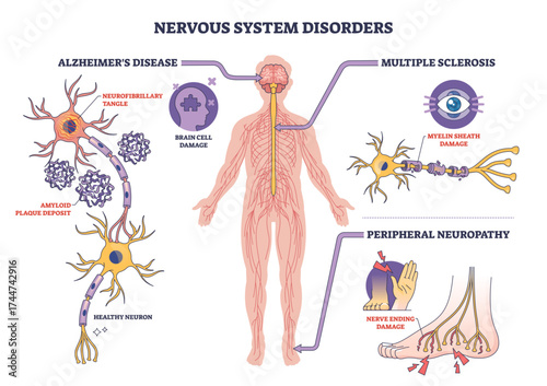 Nervous system disorders are illustrated with labeled diagrams of neurons, brain, and nerves, highlighting key areas of damage, transparent background.