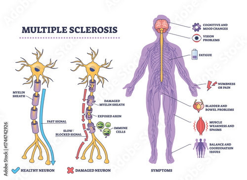 Multiple sclerosis overview showing neuron damage, immune cells, and main symptoms in a clear outline diagram, transparent background.