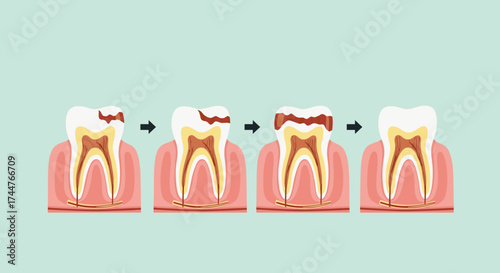 Understanding the progression of tooth decay and how it affects dental health over time.