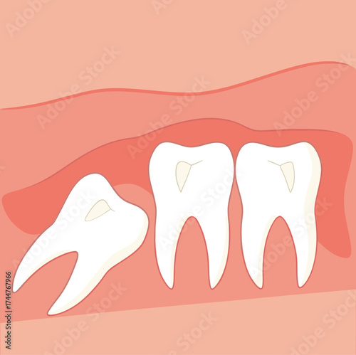 Wisdom tooth. Wisdoms teeth dental problem, gum pain, remove teeths dentist.oral health, toothache. Flat vector illustration

