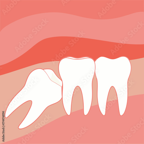 Wisdom tooth. Wisdoms teeth dental problem, gum pain, remove teeths dentist.oral health, toothache. Flat vector illustration

