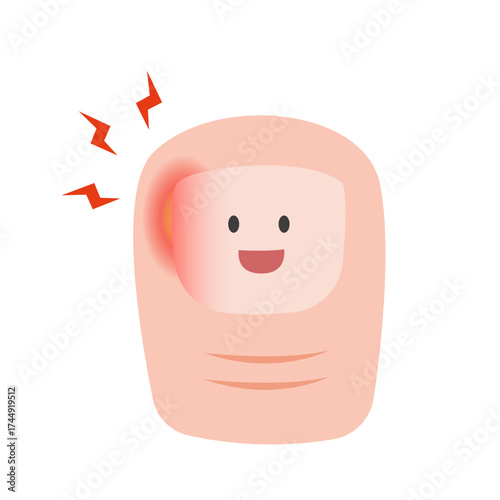 Ingrown Toenail on Foot. vector illustration