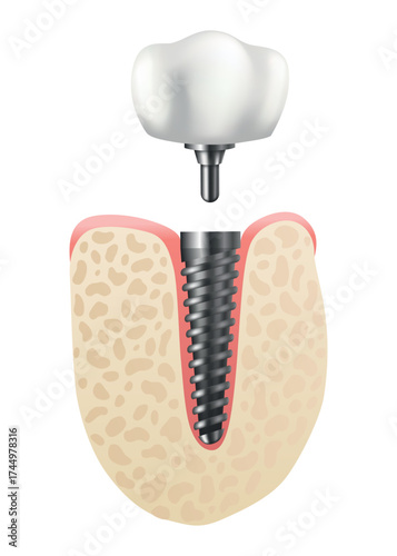 Dental implant structure. Medical educative infographic poster. Teeth implant, realistic vector design of dentistry. Implant screw, healthcare, dentist and orthodontist treatment