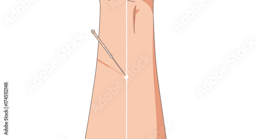 Experience soothing relief as an acupuncture needle gently targets a vital energy point on the skin, promoting wellness and healing