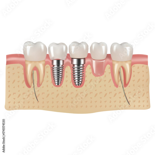 Dental Implants Illustration Healthy Teeth Gum Bone Root Canal Treatment Modern Dentistry Tooth Replacement Dental Care