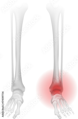 Medical Illustration of foot Anatomy, Inflamed Ankle.