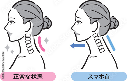 正常な状態とスマホ首の比較イラスト（女性横顔）
