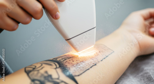 Laser treatment for tattoo removal on forearm in clinic setting  