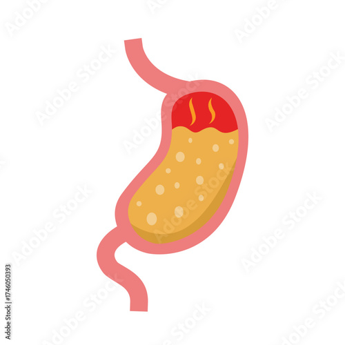Anatomy Of Gastritis Flat Illustration 