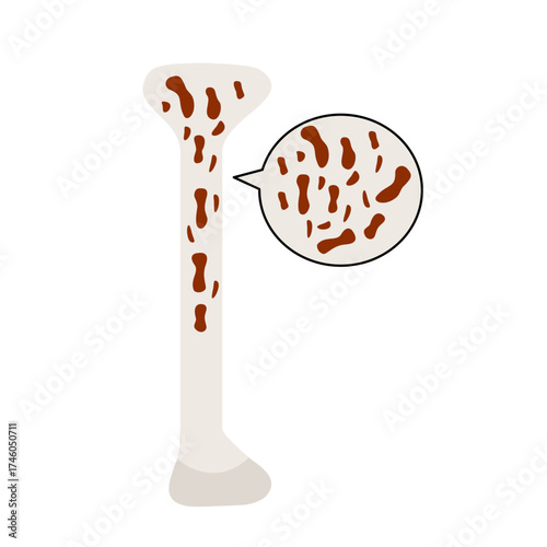 Anatomy Of Bone With Osteoporosis 