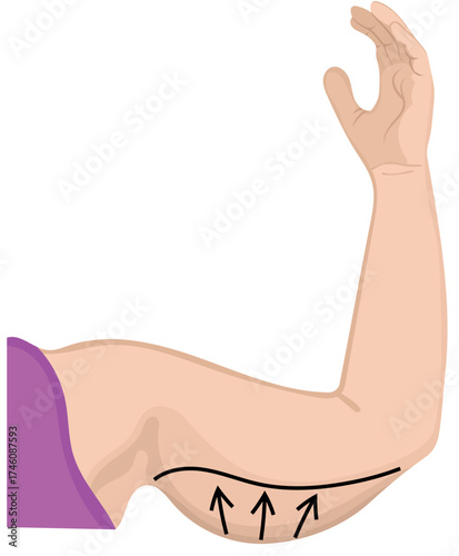 Draw Line on Excess Fat Lower Arm Illustration Isolated on White Background