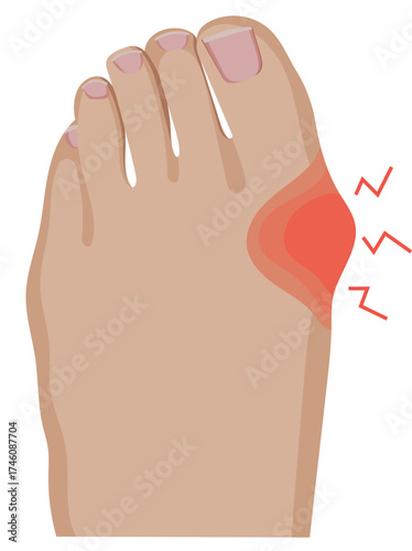 Pain Foot Hallux Valgus Condition Problem Illustration Isolated on White Background
