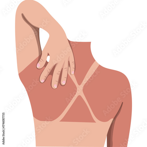 Sunburn Skin Back on a Woman Illustration Isolated on White Background