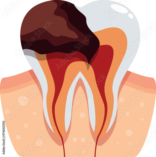 Cross section of a molar tooth showing advanced tooth decay affecting the enamel, dentin, pulp, and root canal