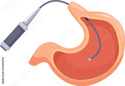 Medical endoscope exploring human stomach during endoscopic examination, healthcare and medical concept