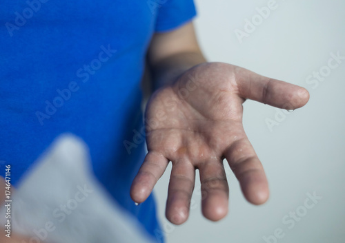 A man suffers from palmar hyperhidrosis. He wipes his sweaty palms due to excessive sweating. Treatment of hyperhidrosis with botulinum toxin injection into the hand.