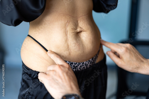 Abdominal skin examination after pregnancy. Close-up of a woman's abdomen being examined for skin laxity and scars after pregnancy.