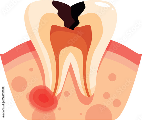 Cross section of molar showing cavity and gum inflammation, highlighting dental health issues