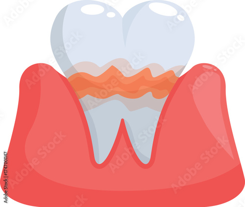 Dental illustration showing tartar buildup causing gingivitis and periodontitis, highlighting the importance of oral hygiene