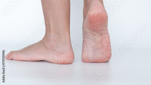 Close-up view of human feet showing corns and calluses, highlighting skin texture and foot health concerns in a clinical setting