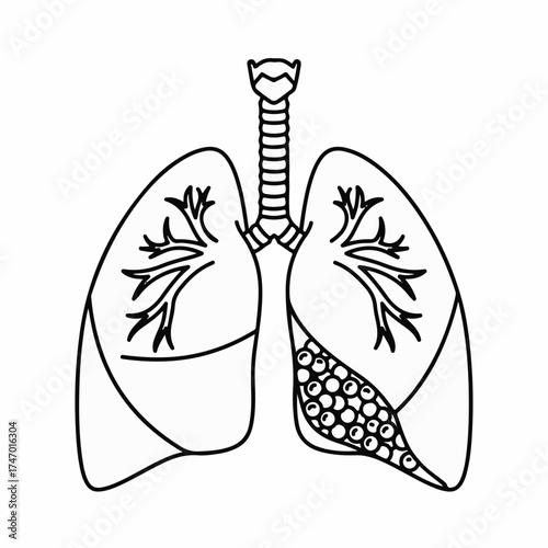 Stylized illustration of human lungs, highlighting a healthy lung and one affected by a condition.