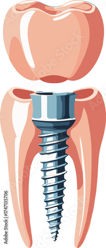 Realistic medical illustration of a dental implant showing a titanium screw integrated into the tooth root structure, used for educational and dental care materials.